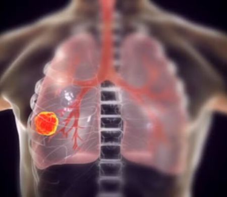 Vacina para prevenir câncer de pulmão inicia estudos em humanos