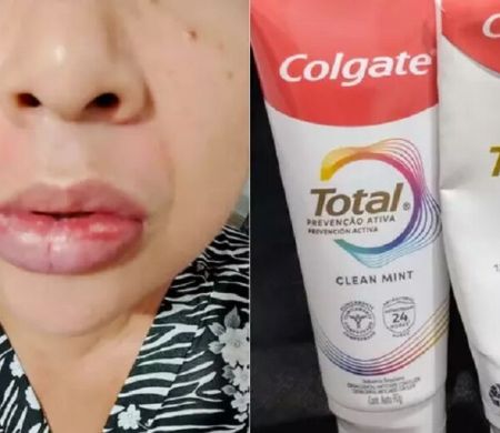 Após reações alérgicas, Colgate suspende fabricação da Clean Mint 