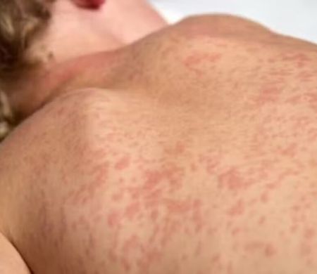 Surto de sarampo na Bolívia e Paraguai coloca MS em alerta