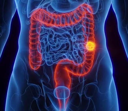SUS exige novo exame para detectar câncer de intestino antes de sintomas